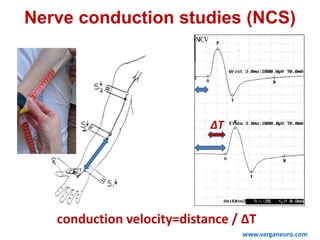 ∆T
conduction velocity=distance / ΔT
Nerve conduction studies (NCS)
www.varganeuro.com
 