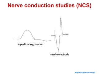 needle electrode
superficial registration
www.varganeuro.com
Nerve conduction studies (NCS)
 