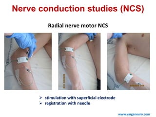  stimulation with superficial electrode
 registration with needle
www.varganeuro.com
Nerve conduction studies (NCS)
Radial nerve motor NCS
 