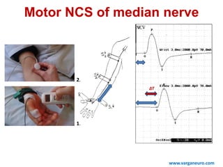 ∆T
www.varganeuro.com
Motor NCS of median nerve
1.
2.
 