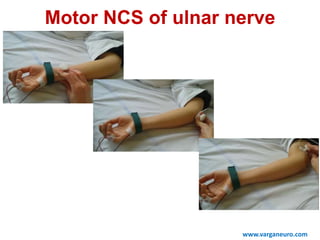www.varganeuro.com
Motor NCS of ulnar nerve
 