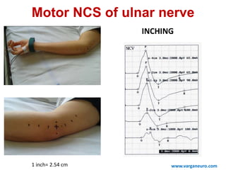 www.varganeuro.com
Motor NCS of ulnar nerve
INCHING
1 inch= 2.54 cm
 