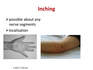 Inching
possible about any
nerve segments
localisation
1 inch= 2.54 cm
 