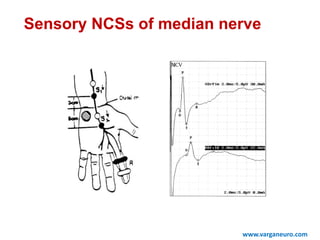 Sensory NCSs of median nerve
www.varganeuro.com
 