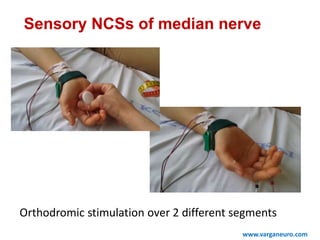 www.varganeuro.com
Sensory NCSs of median nerve
Orthodromic stimulation over 2 different segments
 
