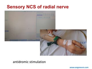 www.varganeuro.com
Sensory NCS of radial nerve
antidromic stimulation
 