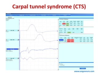 Carpal tunnel syndrome (CTS)
www.varganeuro.com
 