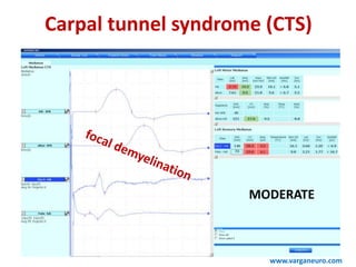 Carpal tunnel syndrome (CTS)
www.varganeuro.com
MODERATE
 