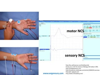 motor NCS
sensory NCS
http://bcs.whfreeman.com/thelifewire9e
Purves et al. Life The Science of Biology IVth Edition 1995.
http://chadwaterbury.com
http://emedicine.medscape.com/article/1846028-overview
http://jdr.sagepub.com
http://www.erikstalberg.com/www.varganeuro.com
 