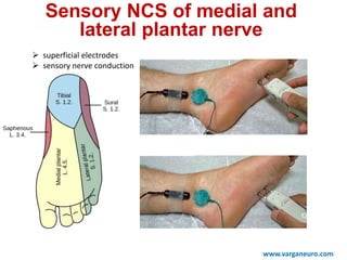  superficial electrodes
 sensory nerve conduction
Sensory NCS of medial and
lateral plantar nerve
www.varganeuro.com
 