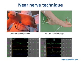 Near nerve technique
tarsal tunnel syndrome Morton’s metatarsalgia
www.varganeuro.com
 