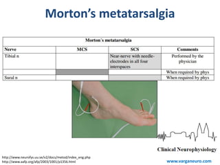 http://www.neurofys.uu.se/v2/docs/metod/index_eng.php
http://www.aafp.org/afp/2003/1001/p1356.html
Morton’s metatarsalgia
www.varganeuro.com
 