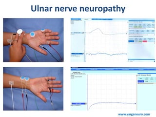 Ulnar nerve neuropathy
www.varganeuro.com
 