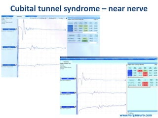 Cubital tunnel syndrome – near nerve
www.varganeuro.com
 