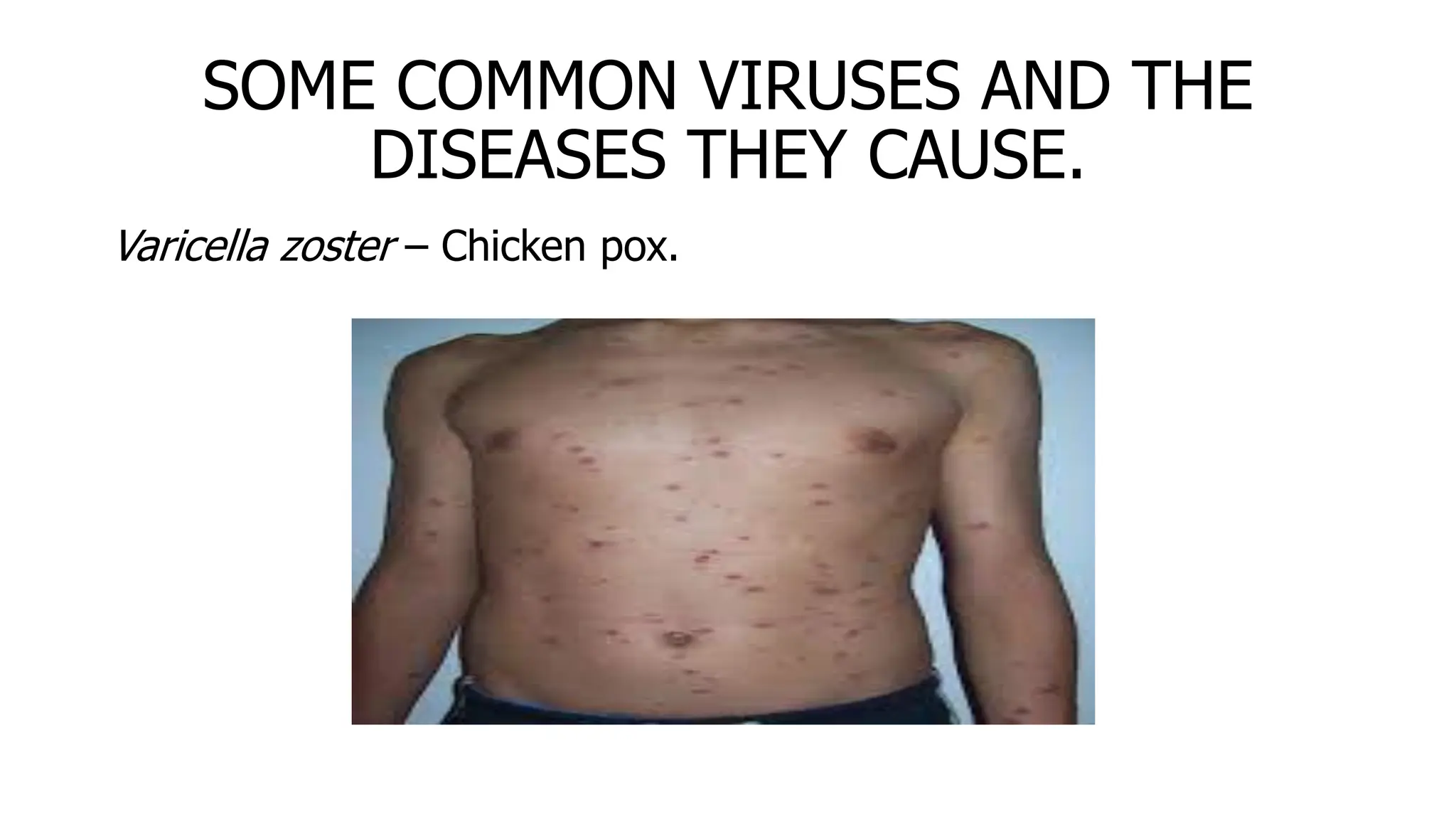 SOME COMMON VIRUSES AND THE
DISEASES THEY CAUSE.
Varicella zoster – Chicken pox.
 