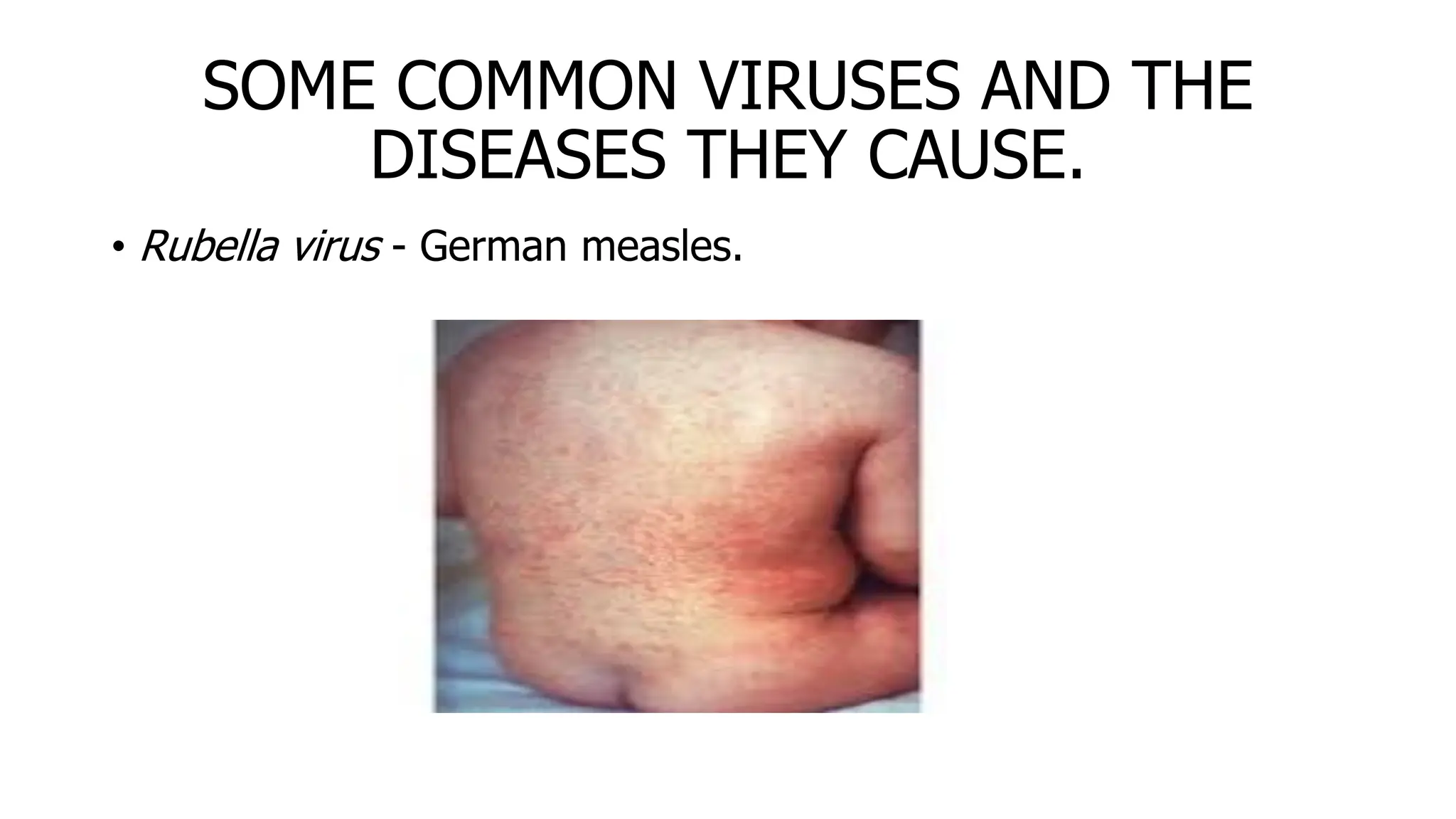 SOME COMMON VIRUSES AND THE
DISEASES THEY CAUSE.
• Rubella virus - German measles.
 