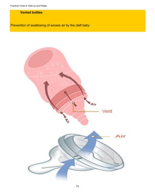 Practical tricks in cleft lip and palate | PDF