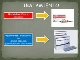 TRATAMIENTO
Doxiciclina: Para la
infección
•Quinolonas: antibióticos
de
amplio espectro.
(ciprofloxacino, ofloxacino)
 