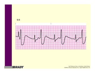 9.9
Gail Walraven, Basic Arrhythmias, Sixth Edition
©2006 by Pearson Education, Inc., Upper Saddle River, NJ
 