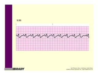 9.99
Gail Walraven, Basic Arrhythmias, Sixth Edition
©2006 by Pearson Education, Inc., Upper Saddle River, NJ
 