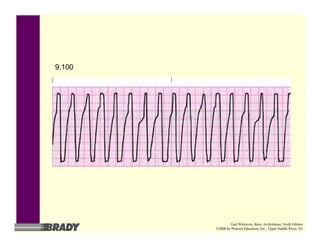 9.100
Gail Walraven, Basic Arrhythmias, Sixth Edition
©2006 by Pearson Education, Inc., Upper Saddle River, NJ
 