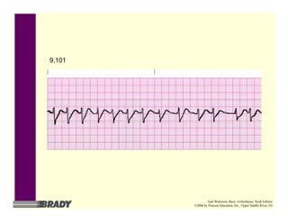 9.101
Gail Walraven, Basic Arrhythmias, Sixth Edition
©2006 by Pearson Education, Inc., Upper Saddle River, NJ
 