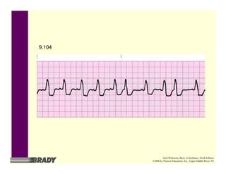 9.104
Gail Walraven, Basic Arrhythmias, Sixth Edition
©2006 by Pearson Education, Inc., Upper Saddle River, NJ
 