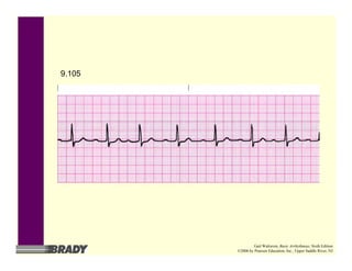 9.105
Gail Walraven, Basic Arrhythmias, Sixth Edition
©2006 by Pearson Education, Inc., Upper Saddle River, NJ
 