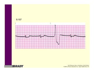 9.107
Gail Walraven, Basic Arrhythmias, Sixth Edition
©2006 by Pearson Education, Inc., Upper Saddle River, NJ
 