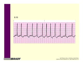 9.10
Gail Walraven, Basic Arrhythmias, Sixth Edition
©2006 by Pearson Education, Inc., Upper Saddle River, NJ
 