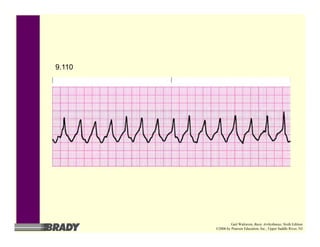 9.110
Gail Walraven, Basic Arrhythmias, Sixth Edition
©2006 by Pearson Education, Inc., Upper Saddle River, NJ
 