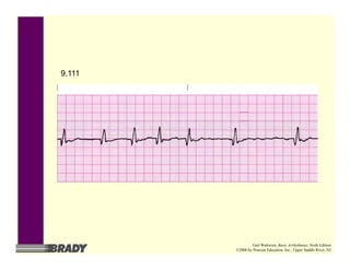 9.111
Gail Walraven, Basic Arrhythmias, Sixth Edition
©2006 by Pearson Education, Inc., Upper Saddle River, NJ
 