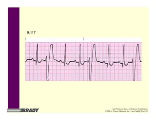 9.117
Gail Walraven, Basic Arrhythmias, Sixth Edition
©2006 by Pearson Education, Inc., Upper Saddle River, NJ
 