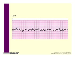 9.11
Gail Walraven, Basic Arrhythmias, Sixth Edition
©2006 by Pearson Education, Inc., Upper Saddle River, NJ
 
