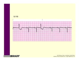 9.119
Gail Walraven, Basic Arrhythmias, Sixth Edition
©2006 by Pearson Education, Inc., Upper Saddle River, NJ
 