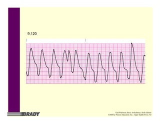 9.120
Gail Walraven, Basic Arrhythmias, Sixth Edition
©2006 by Pearson Education, Inc., Upper Saddle River, NJ
 