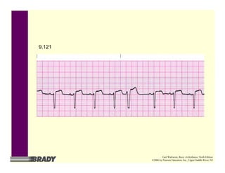 9.121
Gail Walraven, Basic Arrhythmias, Sixth Edition
©2006 by Pearson Education, Inc., Upper Saddle River, NJ
 