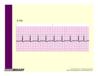 9.125
Gail Walraven, Basic Arrhythmias, Sixth Edition
©2006 by Pearson Education, Inc., Upper Saddle River, NJ
 