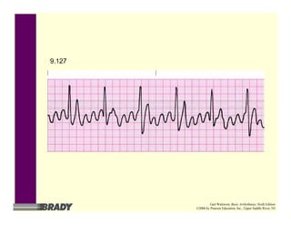 9.127
Gail Walraven, Basic Arrhythmias, Sixth Edition
©2006 by Pearson Education, Inc., Upper Saddle River, NJ
 