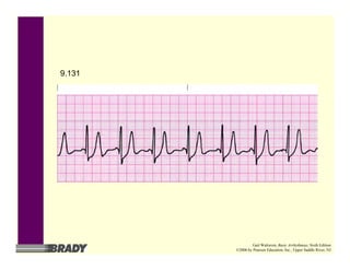 9.131
Gail Walraven, Basic Arrhythmias, Sixth Edition
©2006 by Pearson Education, Inc., Upper Saddle River, NJ
 