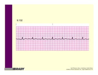 9.132
Gail Walraven, Basic Arrhythmias, Sixth Edition
©2006 by Pearson Education, Inc., Upper Saddle River, NJ
 
