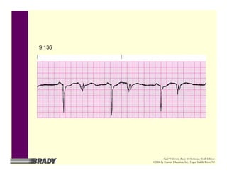 9.136
Gail Walraven, Basic Arrhythmias, Sixth Edition
©2006 by Pearson Education, Inc., Upper Saddle River, NJ
 