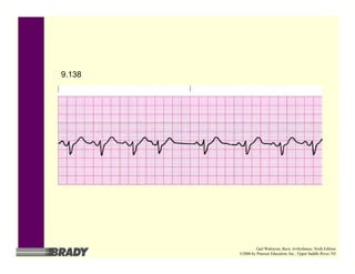 9.138
Gail Walraven, Basic Arrhythmias, Sixth Edition
©2006 by Pearson Education, Inc., Upper Saddle River, NJ
 