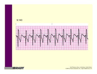 9.143
Gail Walraven, Basic Arrhythmias, Sixth Edition
©2006 by Pearson Education, Inc., Upper Saddle River, NJ
 