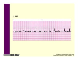 9.149
Gail Walraven, Basic Arrhythmias, Sixth Edition
©2006 by Pearson Education, Inc., Upper Saddle River, NJ
 