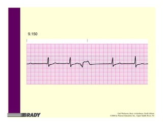 9.150
Gail Walraven, Basic Arrhythmias, Sixth Edition
©2006 by Pearson Education, Inc., Upper Saddle River, NJ
 