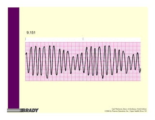 9.151
Gail Walraven, Basic Arrhythmias, Sixth Edition
©2006 by Pearson Education, Inc., Upper Saddle River, NJ
 