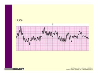 9.156
Gail Walraven, Basic Arrhythmias, Sixth Edition
©2006 by Pearson Education, Inc., Upper Saddle River, NJ
 