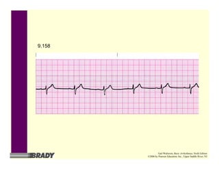 9.158
Gail Walraven, Basic Arrhythmias, Sixth Edition
©2006 by Pearson Education, Inc., Upper Saddle River, NJ
 