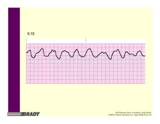 9.15
Gail Walraven, Basic Arrhythmias, Sixth Edition
©2006 by Pearson Education, Inc., Upper Saddle River, NJ
 